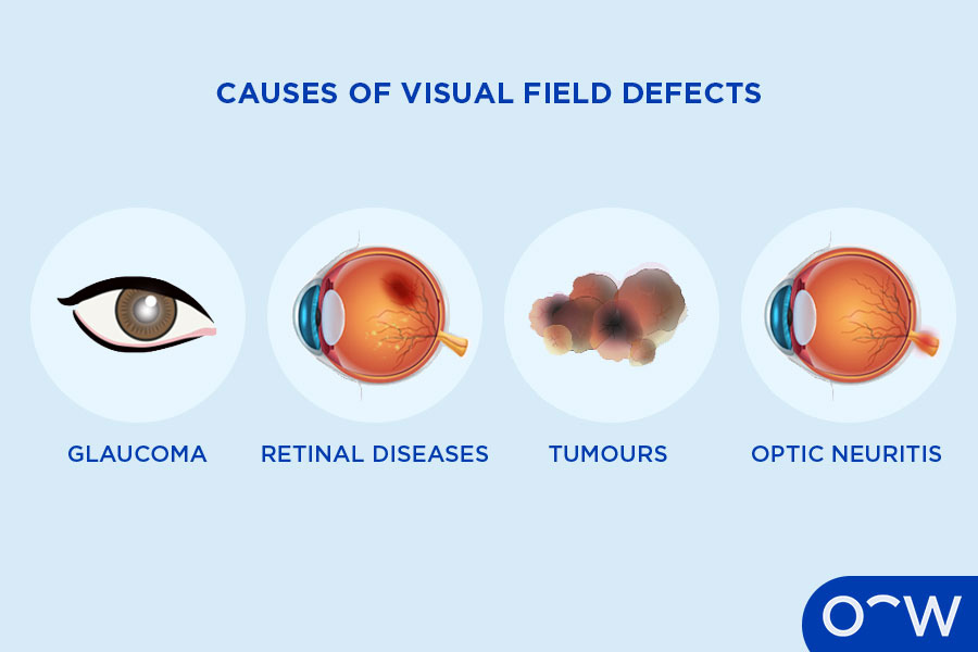 Diagram of four eyes with conditions that cause visual field
defects which are glaucoma, retinal diseases, tumours and optic
neuritis.