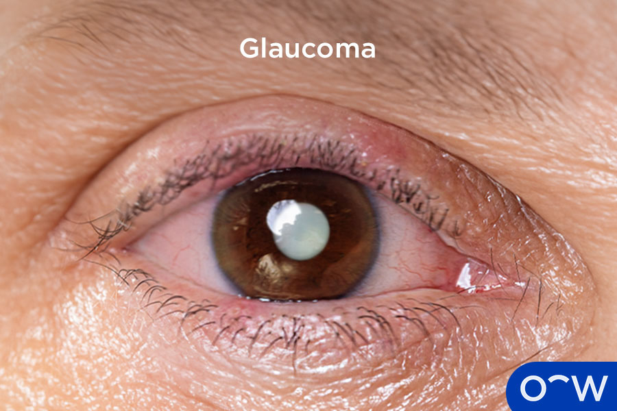 An eye affected by glaucoma