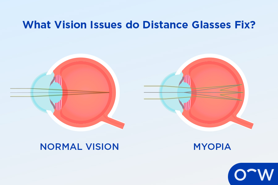 A cross-section of an eye with myopia next to a cross-section of a normal eye.