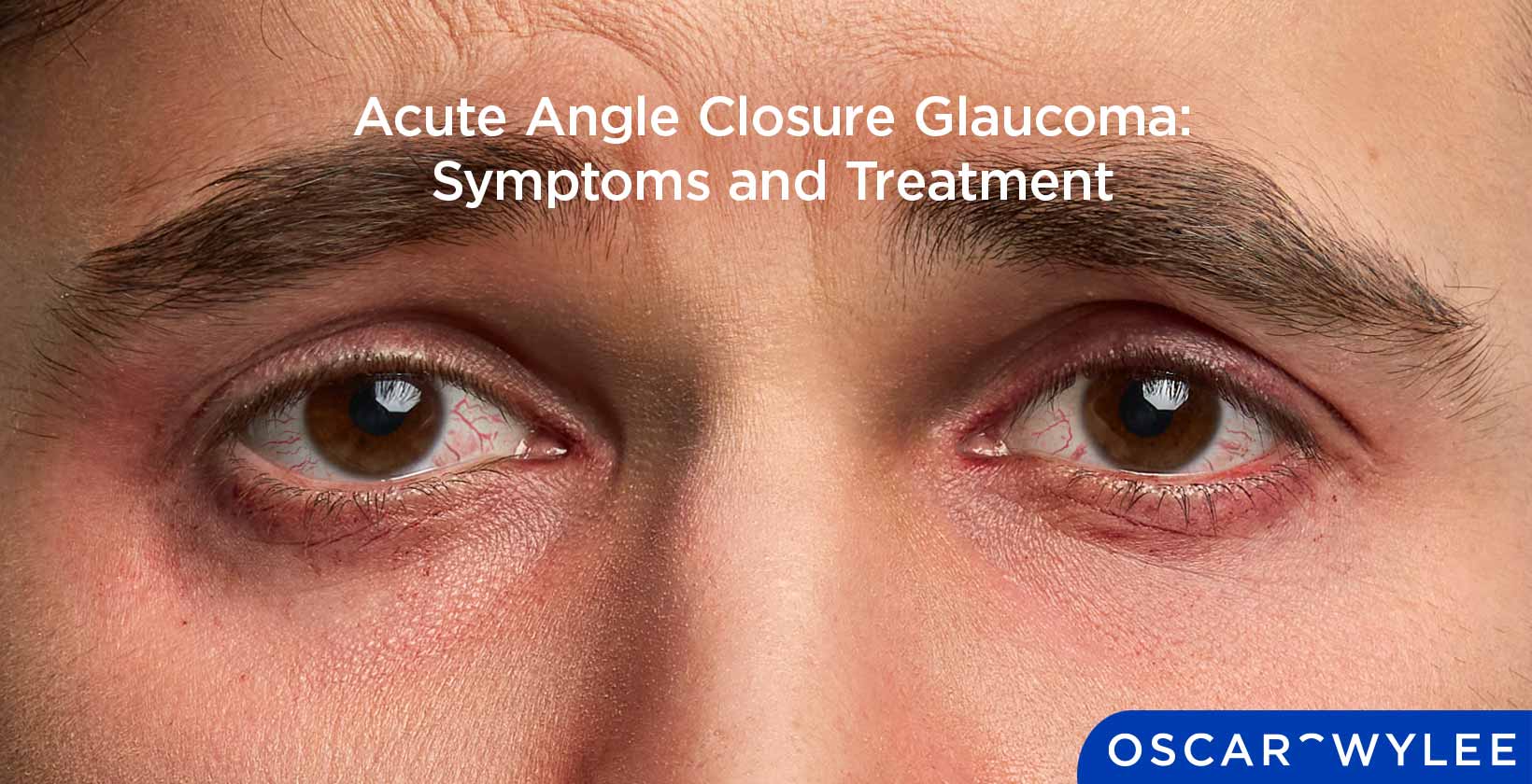 Acute Angle Closure Glaucoma: Symptoms and Treatment