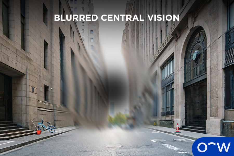 A blurred, hazy spot in someone’s central vision, making the person’s image of a street distorted and hard to see.