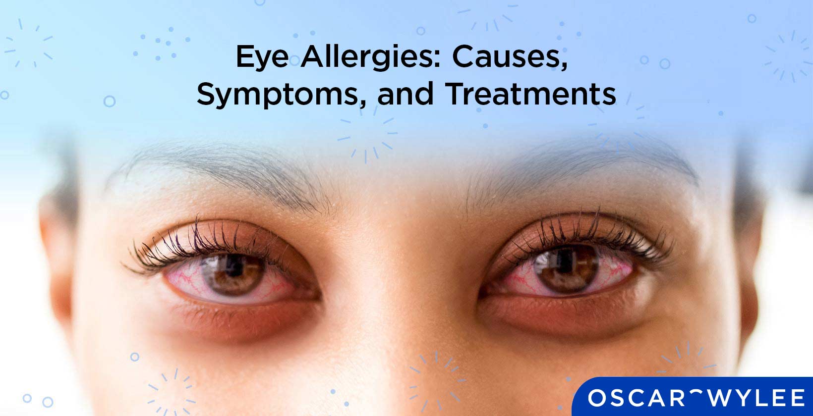 Eye Allergies: Causes, Symptoms, and Treatments