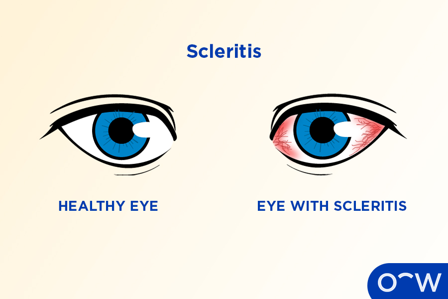 A comparison of an eye that is healthy next to an eye with scleritis.