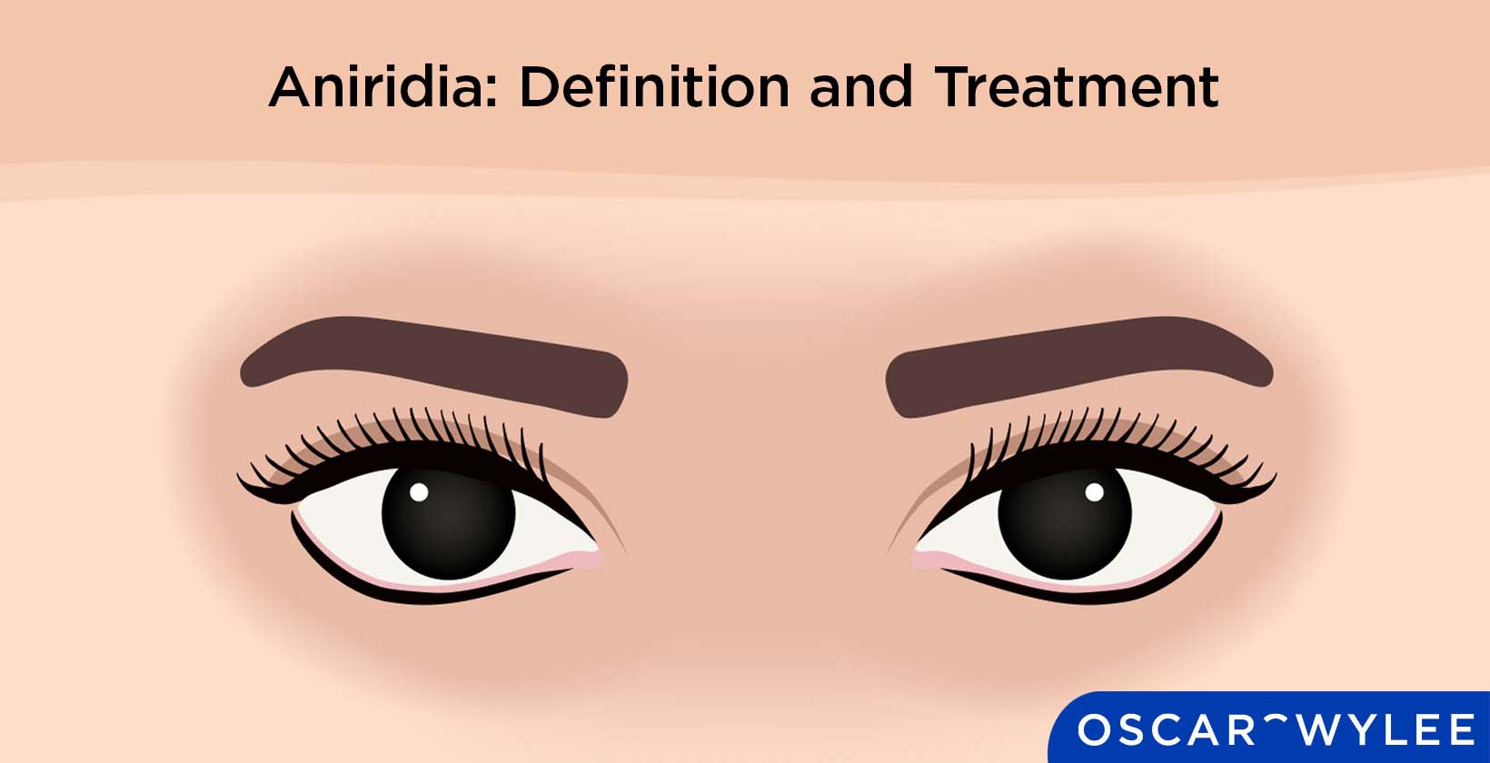 Aniridia: Definition and Treatment.