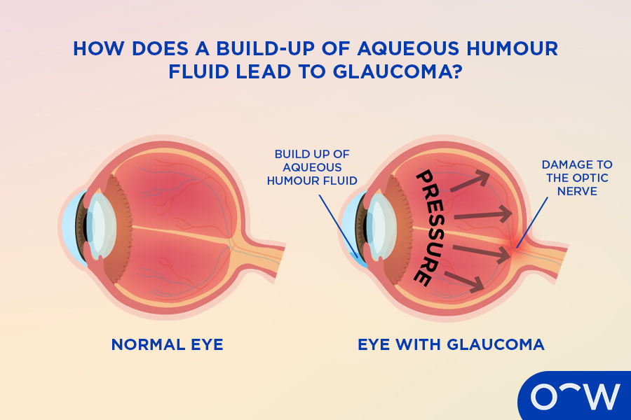 Two cross sections, one of a normal eye and one with glaucoma, showing how a build-up of aqueous humour can lead to glaucoma.