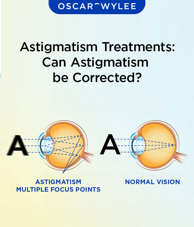 Treatment for Astigmatism