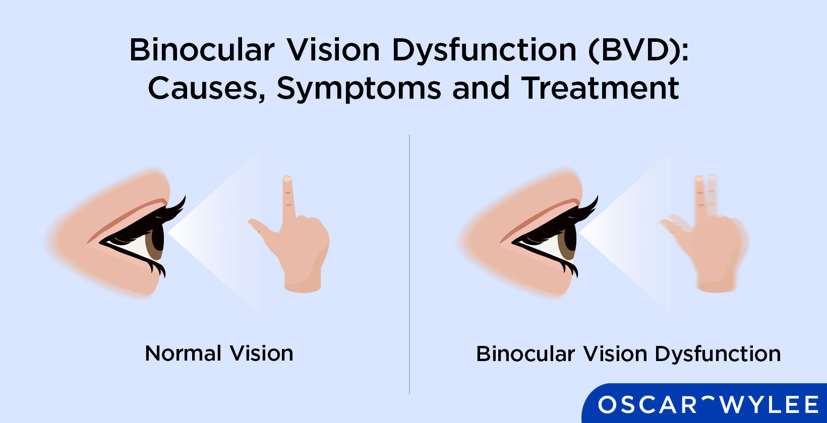 Binocular Vision Dysfunction (BVD): Causes, Symptoms and Treatment