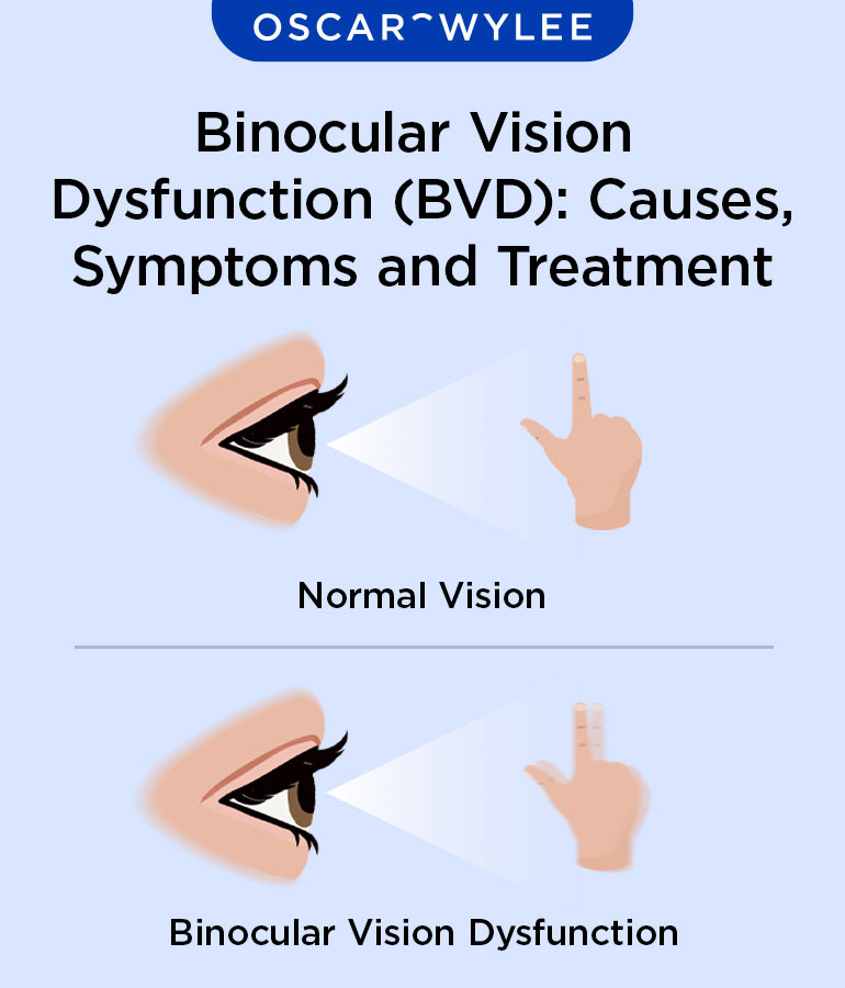 Binocular Vision Dysfunction (BVD): Causes, Symptoms and Treatment