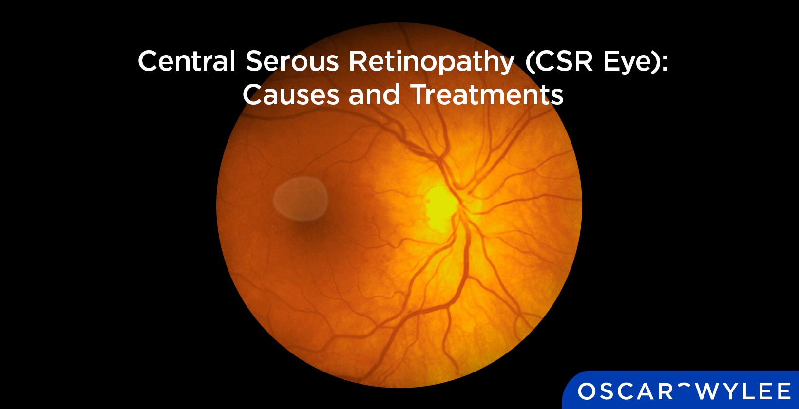 Central Serous Retinopathy
