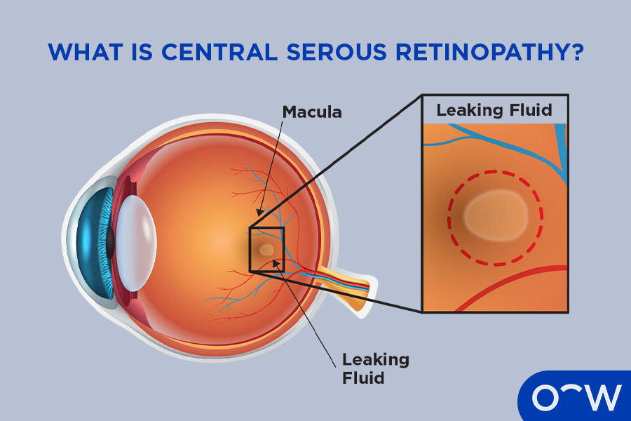A diagram showing the macula and how leaking fluid goes into it.