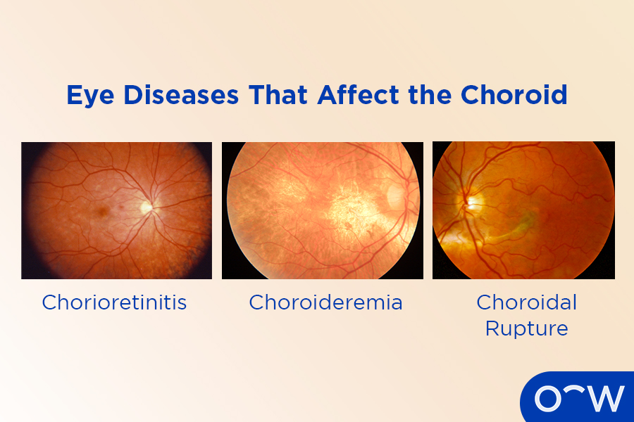 Three eyeballs, one with chorioretinitis, one with choroideremia and one with a choroidal rupture.