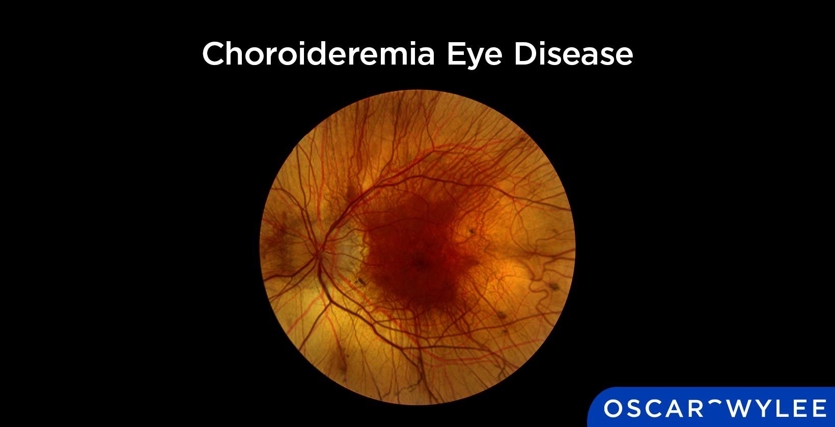 Choroideremia Eye Disease