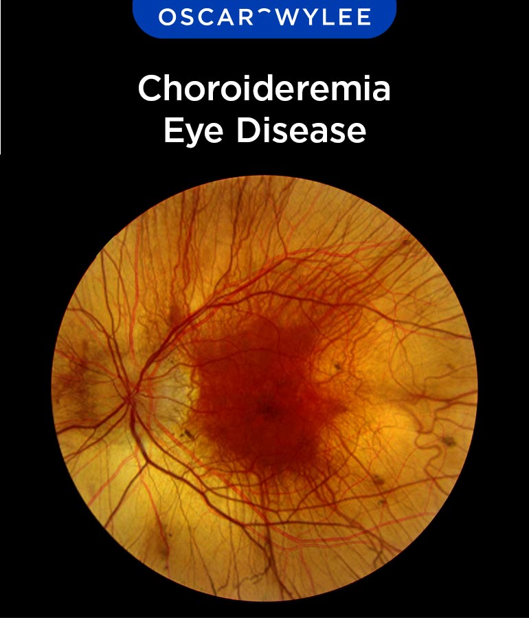 Choroideremia Eye Disease