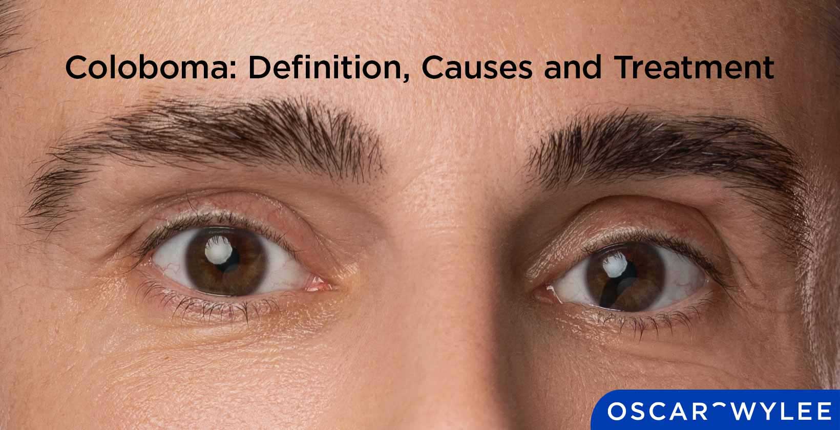 Coloboma: Definition, Causes and Treatment