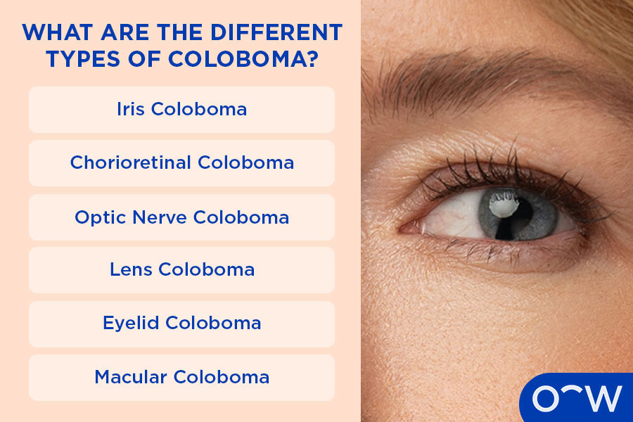 Infographic explaining the different types of Coloboma