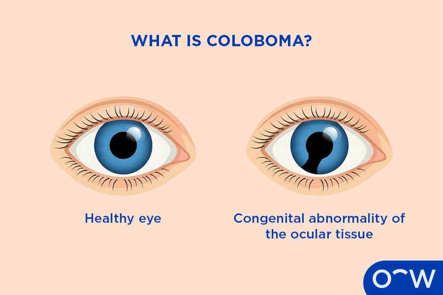 Labelled graphic explaining that coloboma is a congenital abnormality