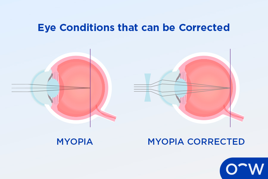 Illustration of myopia-affected eyes being corrected, changing how the light is refracted from the eye.