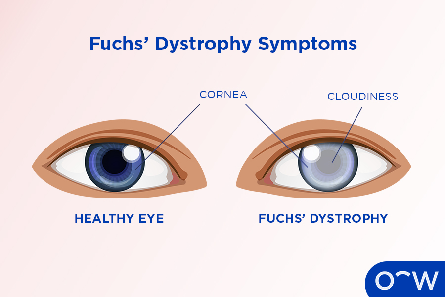 Graphic of a healthy eye displaying no symptoms next to an eye affected by Fuchs’ Dystrophy showing signs of cloudiness.