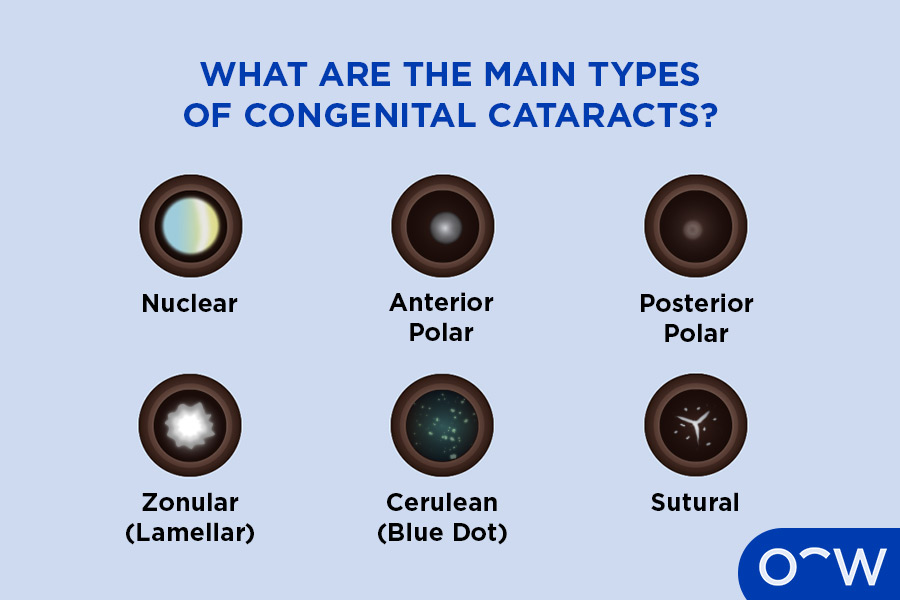 Images of the 6 main types of congenital cataracts