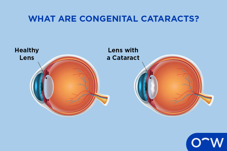 An anatomical diagram showing that a congenital cataract is a cloudy patch in the clear lens inside the eye that is present at birth or develops during the first year of life