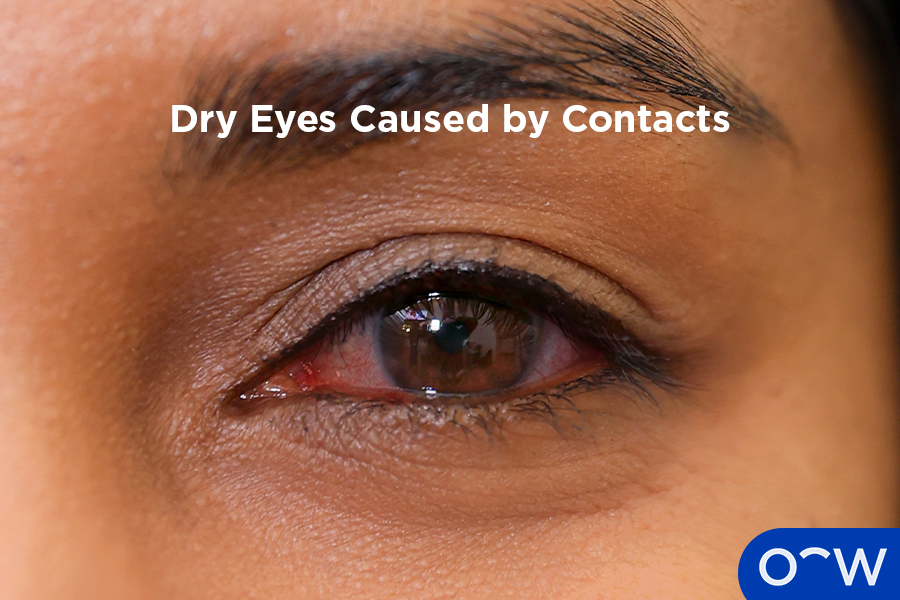 A person with dry eyes caused by wearing contact lenses.