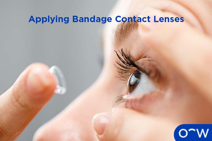Application of bandage contact lenses