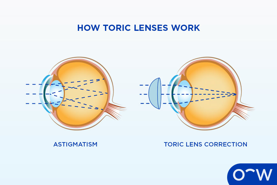 A cross section of an eye demonstrating how astigmatism works, next to another cross section of an eye showing how a toric lens corrects astigmatism in the eye.