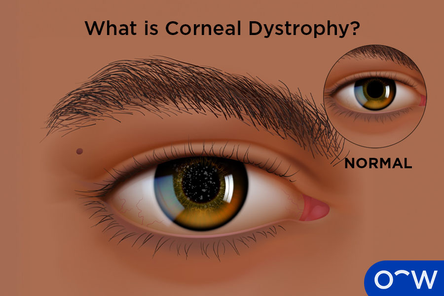 A close-up of a cornea affected by corneal dystrophy.