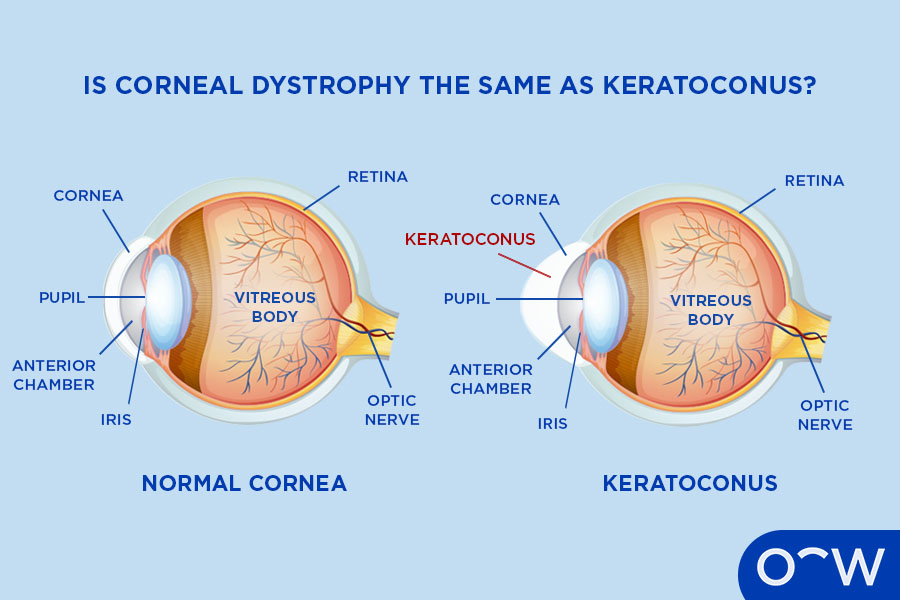 A diagram of a normal cornea, next to a diagram of a cornea with keratoconus