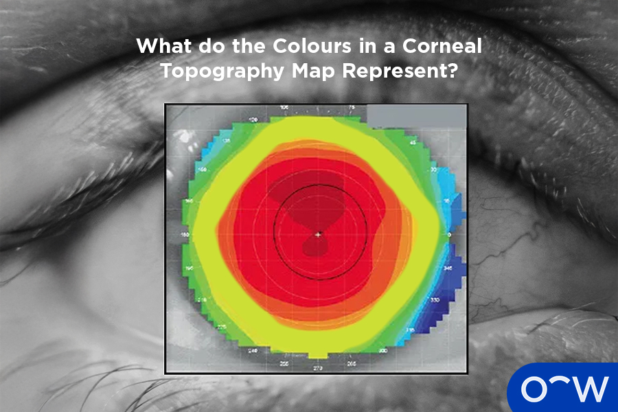 A photo of an example of a corneal topography reading.