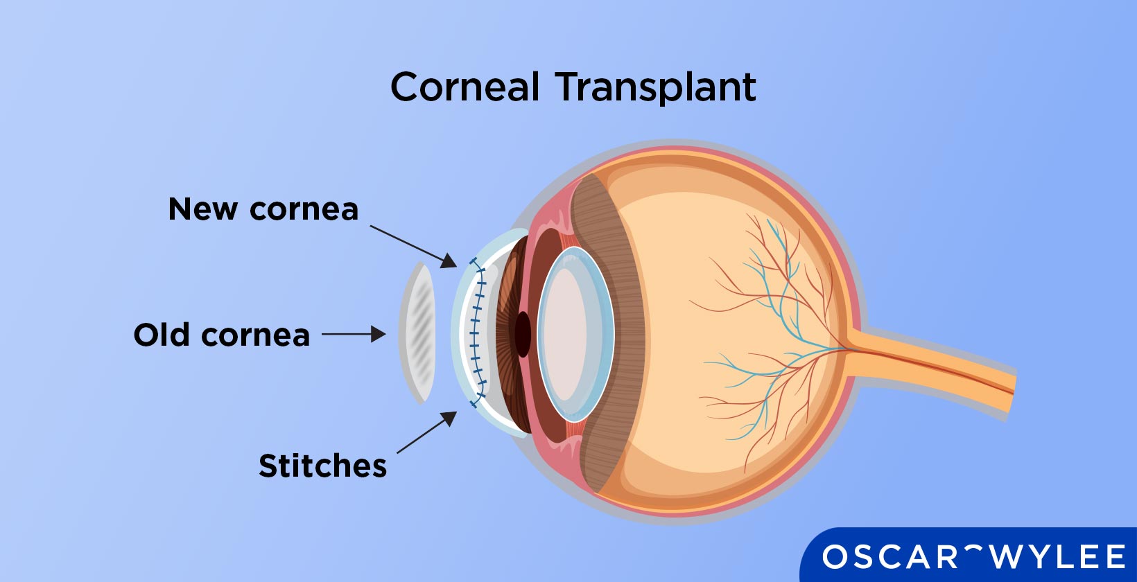 Corneal Transplant: Surgery, Transplant and Recovery