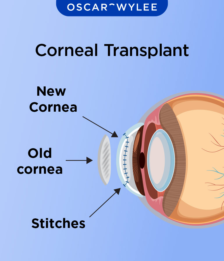 Corneal Transplant: Surgery, Transplant and Recovery