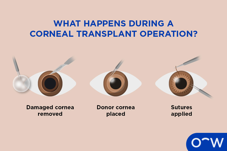 Stages of a corneal transplant