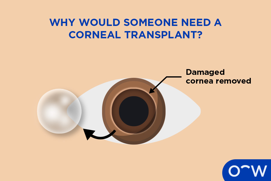 An illustrated eye with its cornea removed due to damage