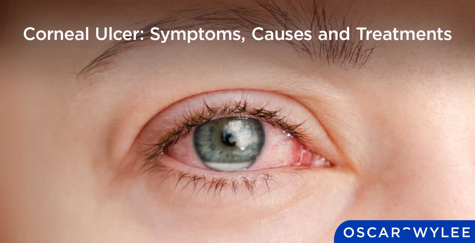 Corneal Ulcer