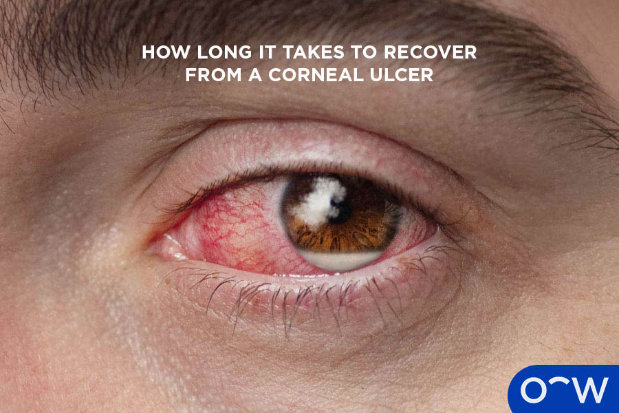 A photo of a close up of an eye affected by a corneal ulcer.