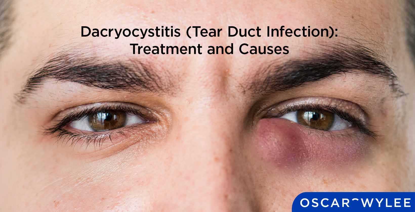 Dacryocystitis (Tear Duct Infection): Treatment and Causes