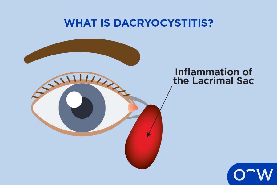 Labelled graphic explaining that dacryocystitis is inflammation of the lacrimal sac