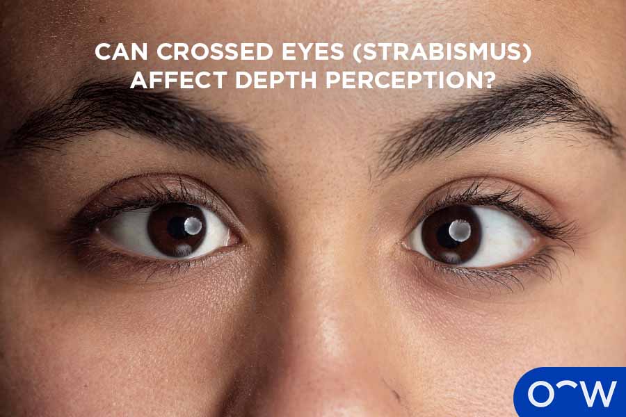 A photo of eyes that are affected by strabismus.