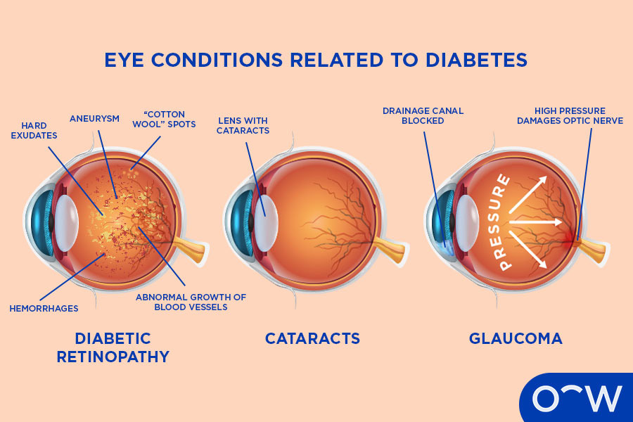 Diagram of three eyeballs with diabetic eye disease.