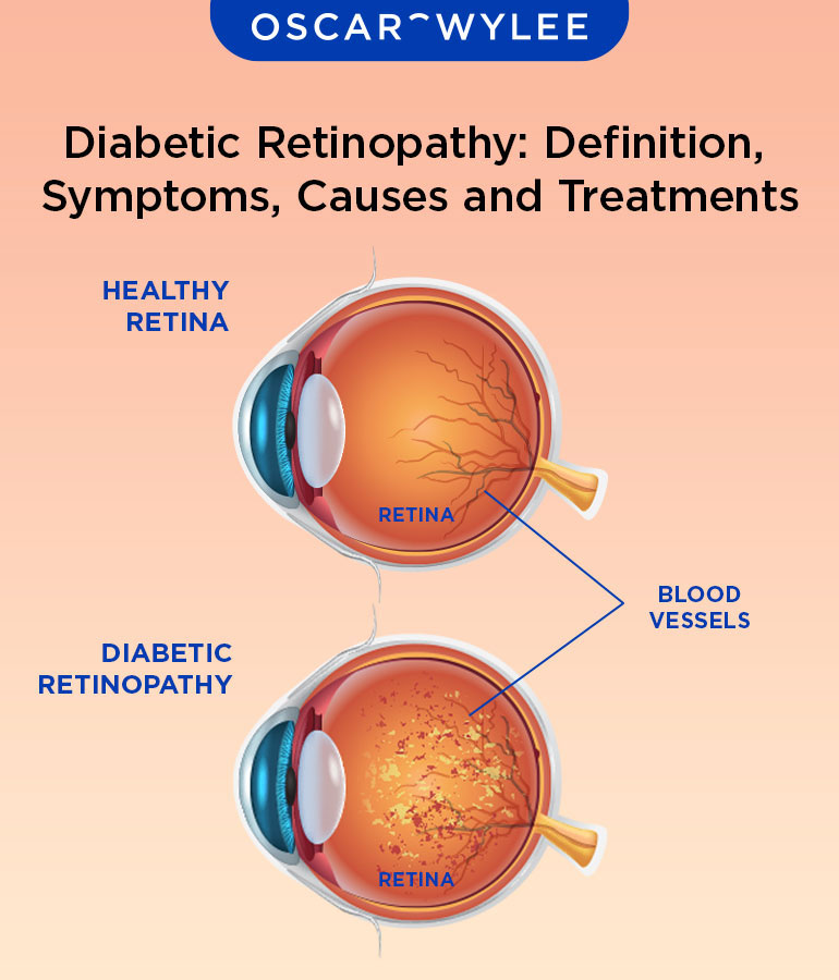 Diabetic Retinopathy Definition Symptoms Causes And Treatments