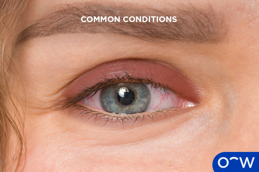 An eye showing swollen and red eyelids, indicating blepharitis.