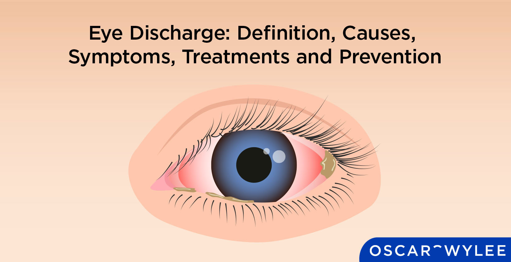 Eye Discharge