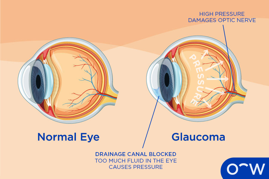 Glaucoma Ophthalmologist