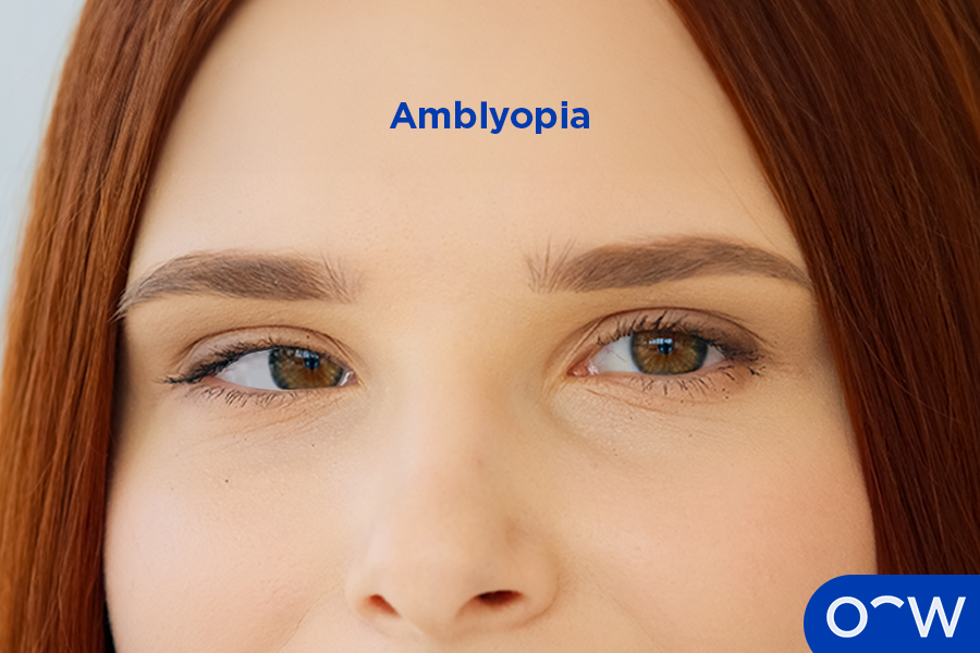 A woman with a lazy eye or amblyopia.