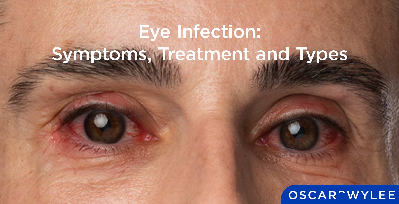 Eye Infection: Symptoms, Treatment and Types