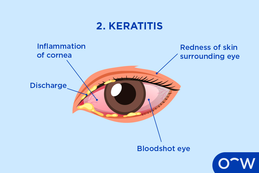 An eye affected by Keratitis with the symptoms listed: cornea inflammation, discharge, surrounding redness and bloodshot eyes.