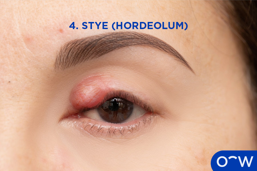 An eyelid affected by a stye (hordeolum).