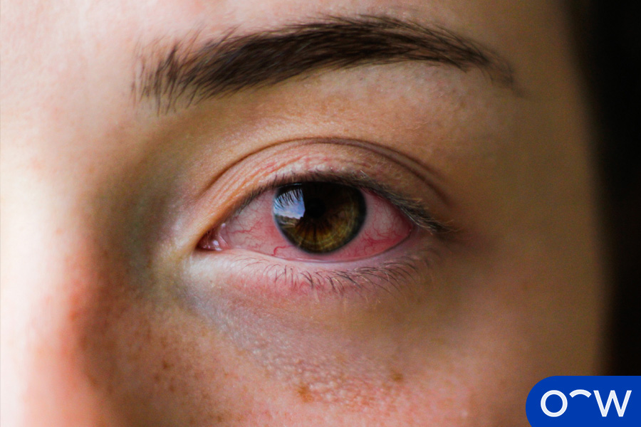 Sore or Irritated Eyes