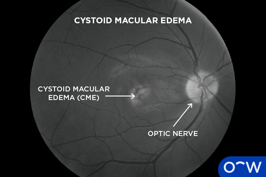 Fluorescein Angiography results indicated signs of cystoid macula edema, one of the many eye diseases that can be detected.
